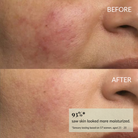 Close-up of a woman's cheek before and after skincare, showing reduced redness and smoother skin after using IREN Shizen DROP OF DEW Moisturizing Facial Oil. 93% saw more moisturized skin; formulated with cold-pressed oils for barrier repair.