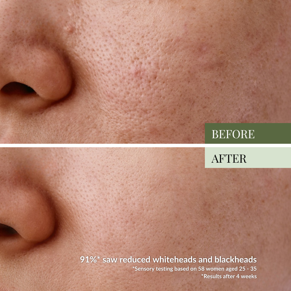 Close-up of a person's cheek and nose shows skin texture before and after using the GLOW UP Anti-Aging Discovery Kit by IREN Shizen; the after image reveals smoother skin with reduced pores and blemishes.